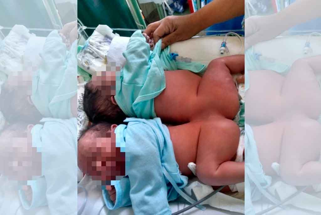 Siameses de padres venezolanos fueron separados tras una operación de 7 horas en hospital de Arequipa