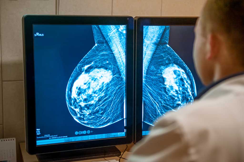 Impacto de la inteligencia artificial en el diagnostico del cáncer de mama